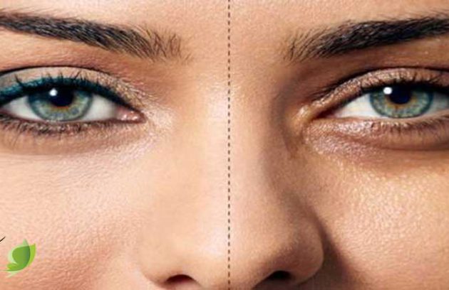 مهمترین عوامل بوجود آمدن سیاهی دور چشم و روشهای درمان آن