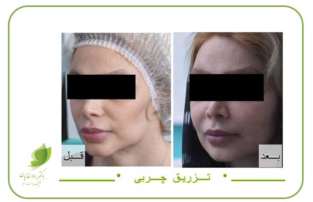 تزریق چربی صورت در مطب دکتر رادا خانیان