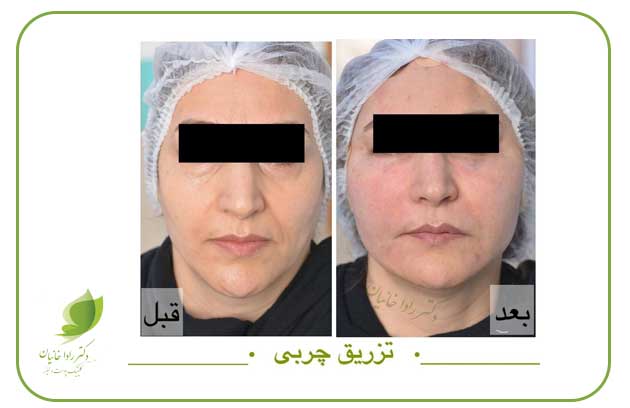 تزریق چربی کل صورت در مطب دکتر رادا خانیان