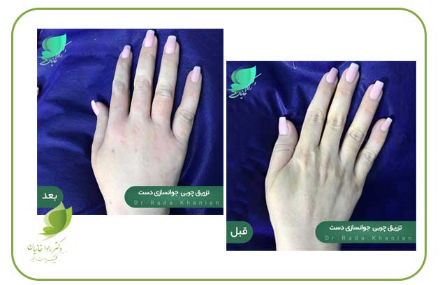 جوانسازی دست با تزریق چربی در مرکز دکتر رادا خانیان