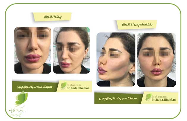 مادلینگ صورت با تزریق چربی در کلینیک زیبایی دکتر رادا خانیان کرمانشاه