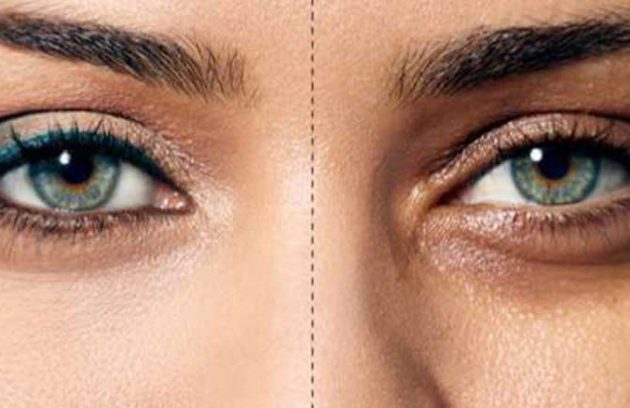 روش های درمانی برای پف و سیاهی دور چشم