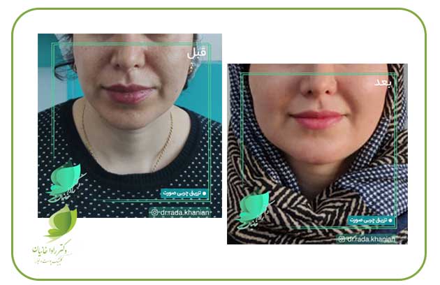 مادلینگ و زاویه سازی صورت با تزریق چربی در مطب دکتر رادا خانیان