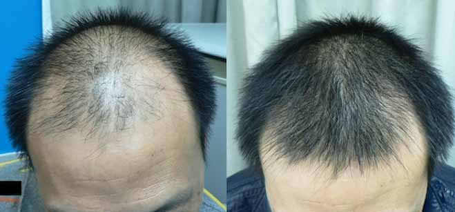 برای درمان ریزش مو مزوتراپی بهتر است یا پی آر پی؟
