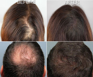 برای درمان ریزش مو مزوتراپی بهتر است یا پی آر پی؟