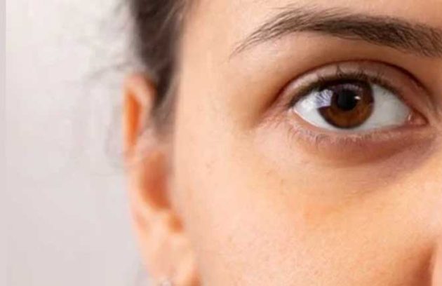 روش های درمانی برای رفع گودی زیر چشم