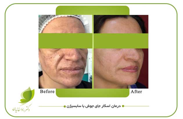 درمان جای جوش با سابسیژن در مرکز زیبایی دکتر رادا خانیان کرمانشاه