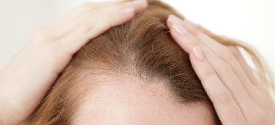 اختلال تیروئید و تاثیر آن بر ریزش مو
