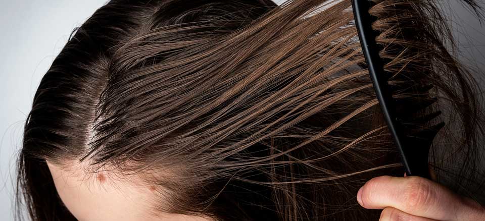 تاثیر چربی کف سر بر ریزش مو | دکتر رادا خانیان